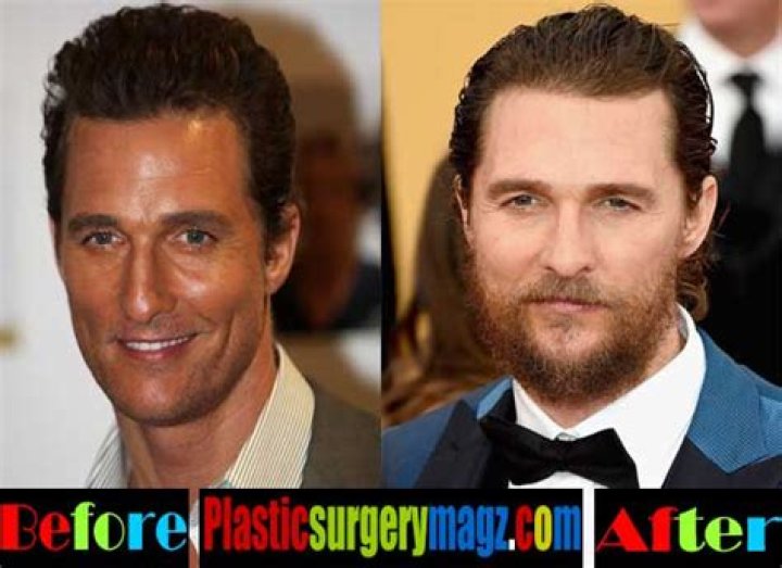 Matthew McConaughey Plastic Surgery Before and After